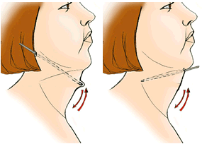 face-neck-contouring.gif (285×204)