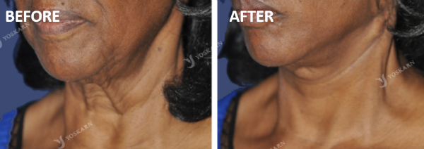 threadlift face and neck (1).png (600×212)