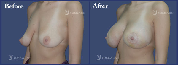 Breast Lift _ Implant.jpg (600×222)