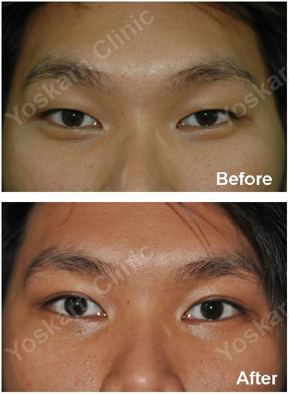 Double Eyelid Surgery 