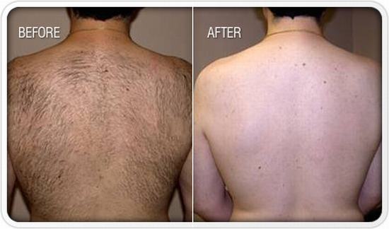 laser hair removal Thailand