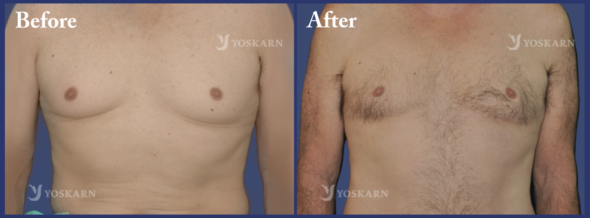 breast surgery Thailand