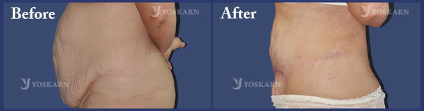abdominal surgery Bangkok