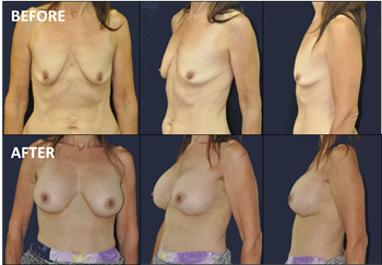 Breast implant Thailand