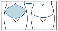 drawing_tummy_tuck_incisions_excess_skin_removal_vs_full_tummy_tuck_diagram.gif (200×109)