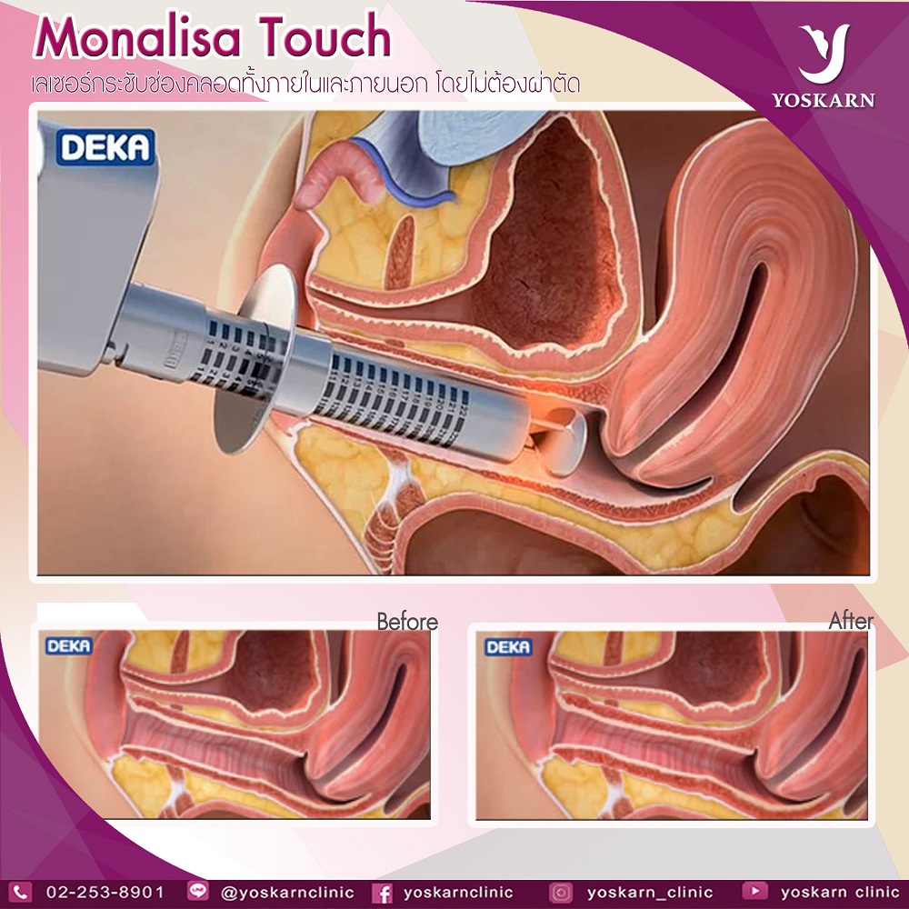 MonaLisa Touch Thailand